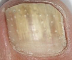 One treatment with holes in nail plate